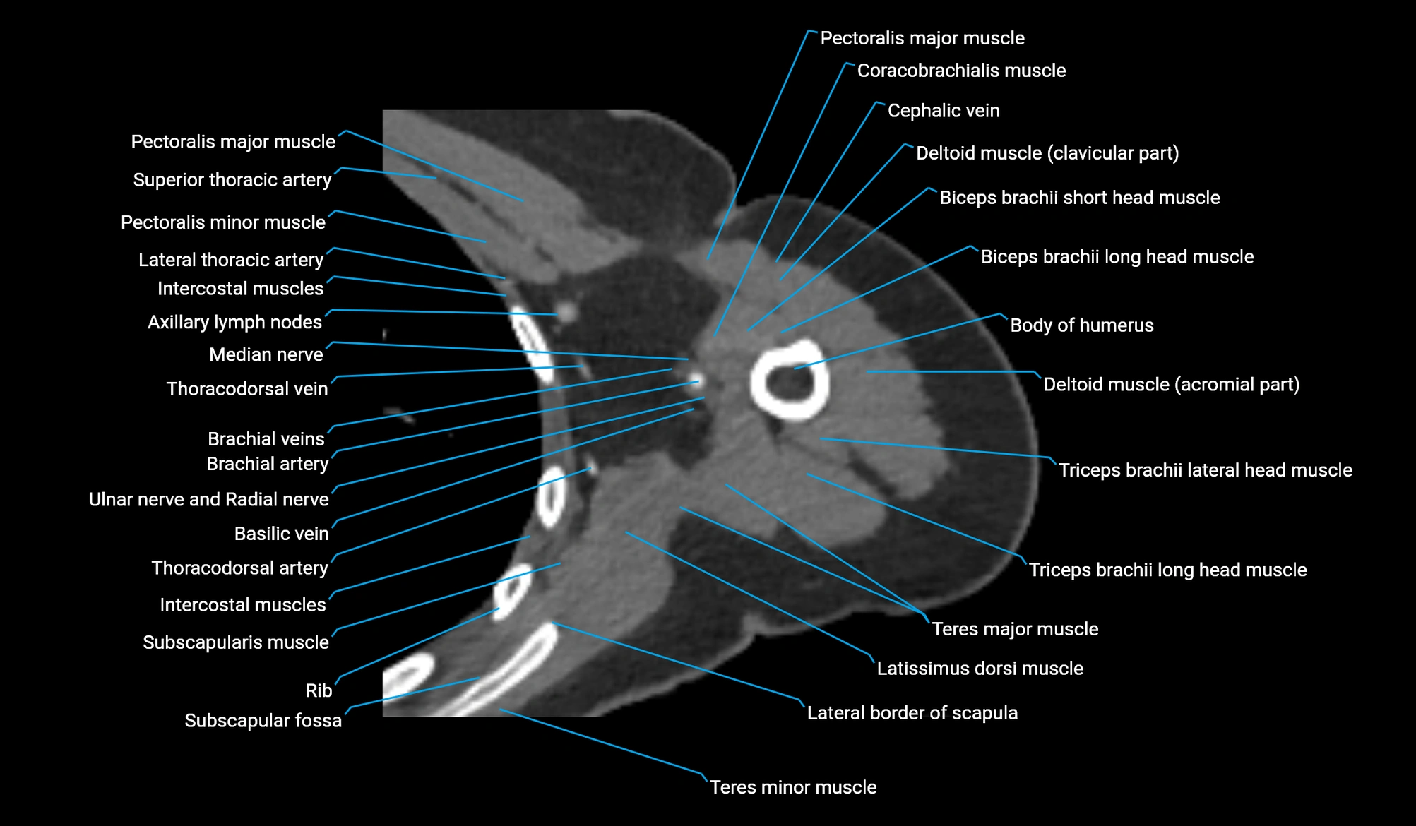 CT upper arm axial  cross sectional anatomy labelled radiology image -00158.webp